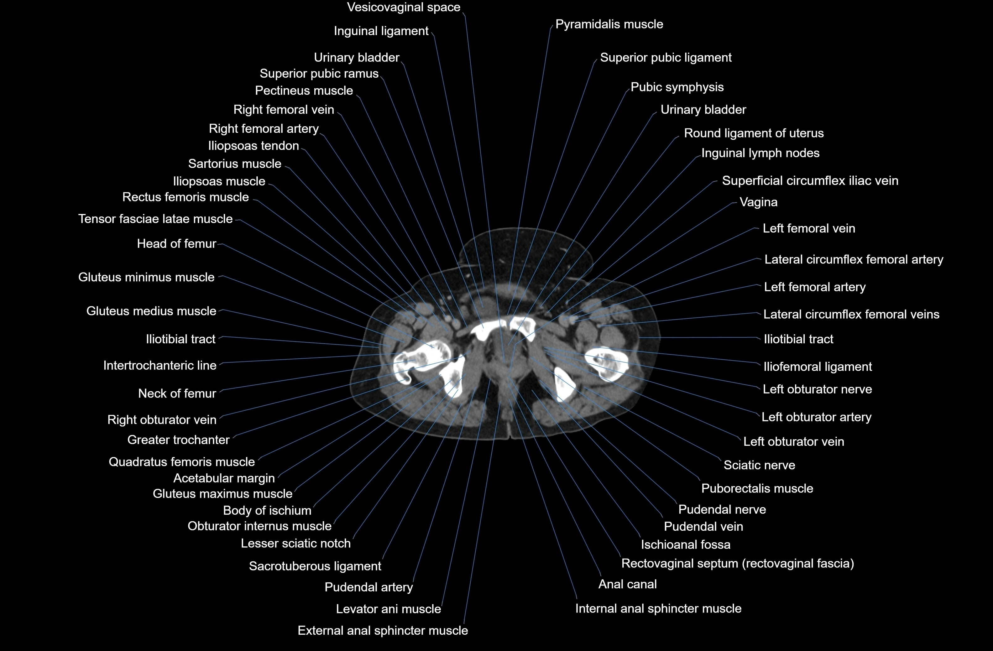 CT Abdomen axial cross sectional anatomy labelled radiology image-00097.webp
